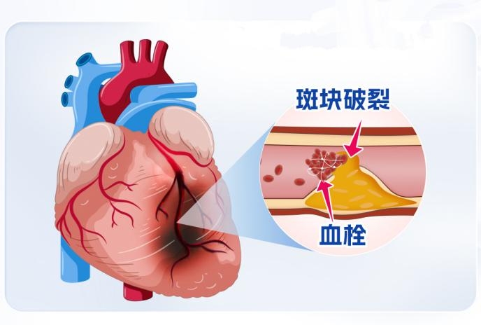 掌控人生压力值，别让心脏负重前行！